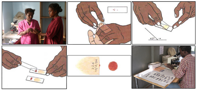 Blood smear workflow for Malaria detection 疟原虫检测的血涂片工作流程